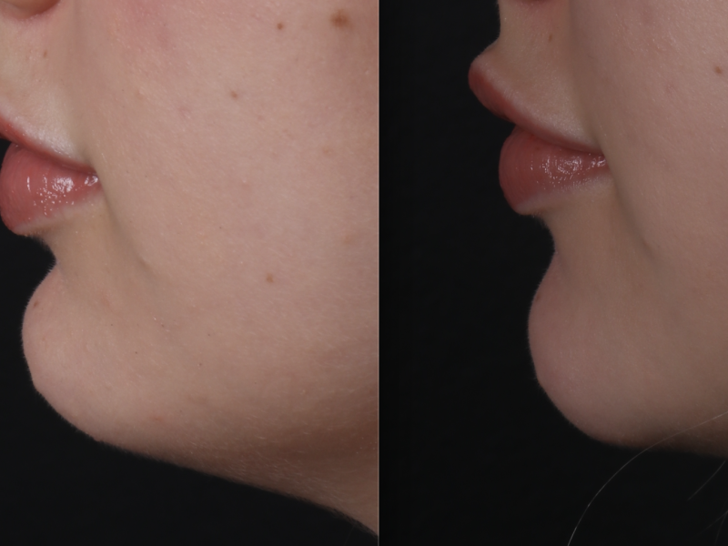 Çene Dolgusu (Jawline)