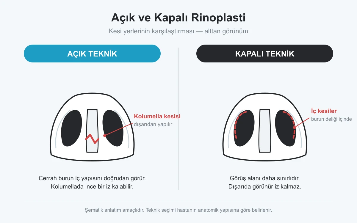 Açık ve kapalı rinoplastide kesi yerlerinin karşılaştırması: kolumella kesisi ile burun deliği içi kesiler