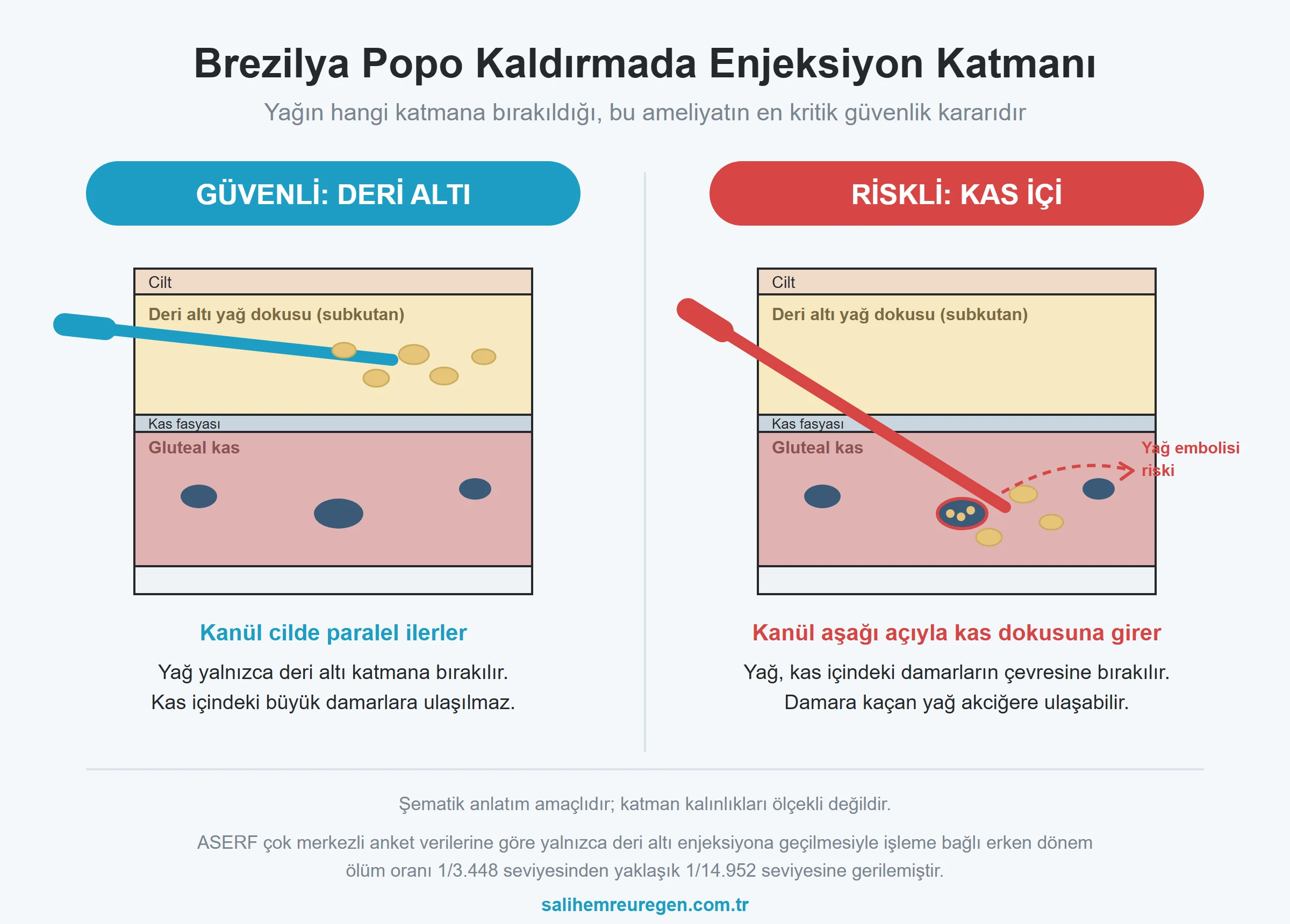 Brezilya popo kaldırmada güvenli enjeksiyon katmanı: deri altı yağ transferi ile kas içi enjeksiyonun karşılaştırıldığı anatomik şema