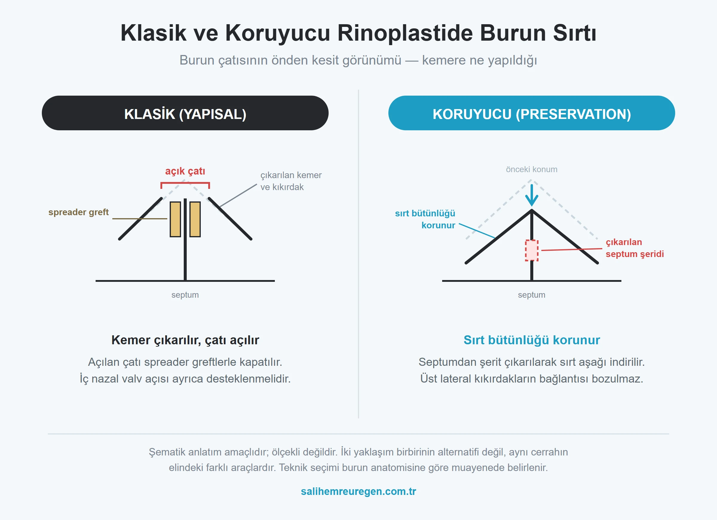 Klasik ve preservation rinoplastide burun sırtının karşılaştırması: kemerin çıkarılması ve açık çatı ile sırt bütünlüğünün korunarak aşağı indirilmesi